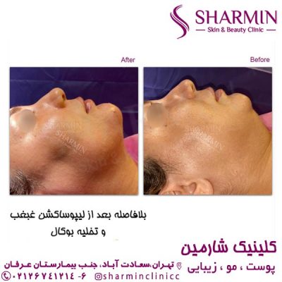 جراحی تخلیه بوکال - کلینیک شارمین