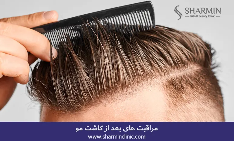 مراقبت بعد از کاشت مو