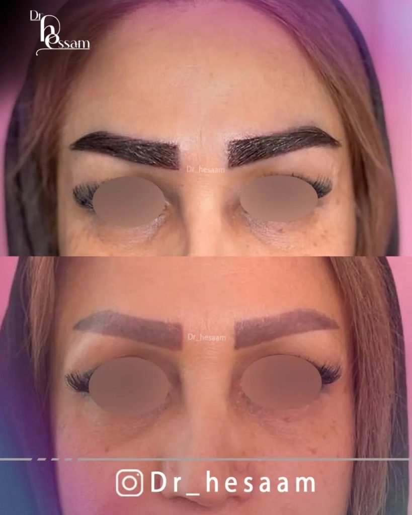 نحوه انجام کاشت ابرو