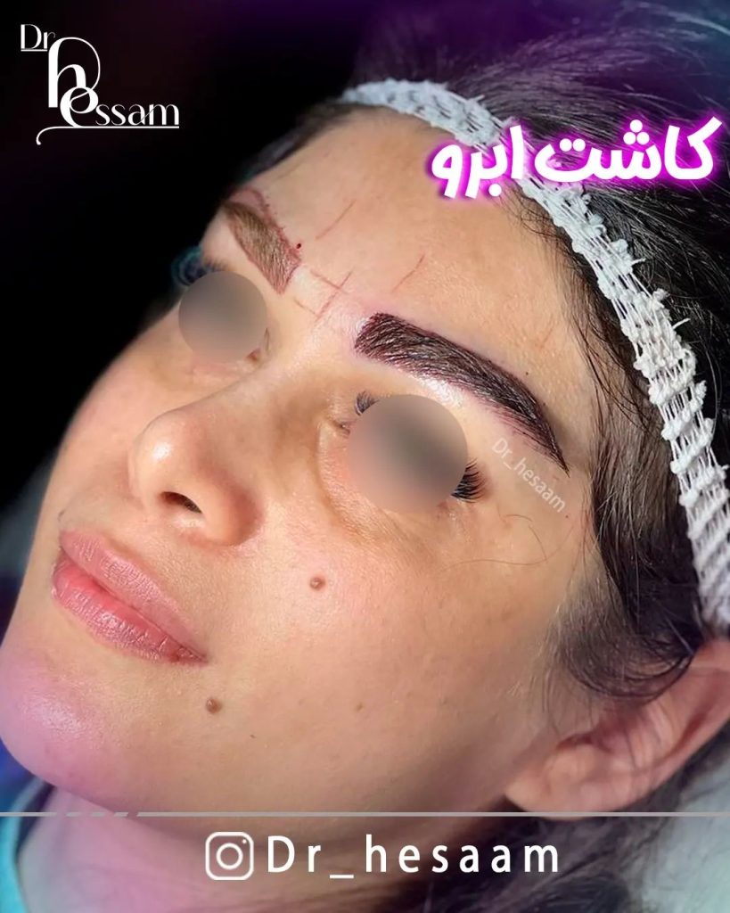 نحوه کاشت ابرو