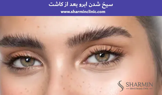 سیخ شدن ابرو بعد از کاشت