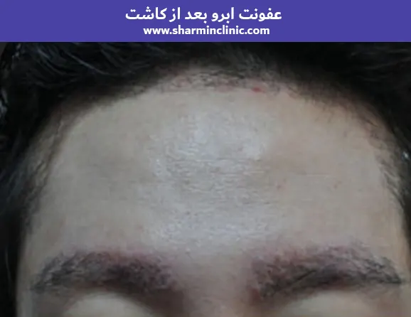 عفونت ابرو بعد از کاشت