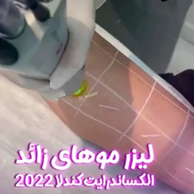 هزینه لیزر موهای زائد