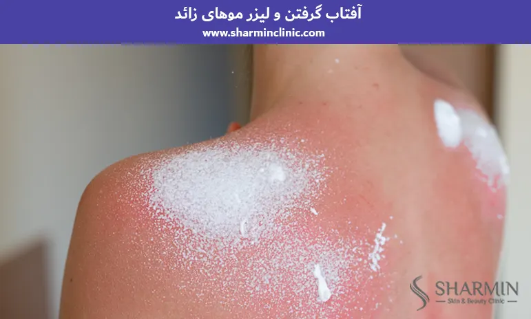 آفتاب گرفتن و لیزر موهای زائد