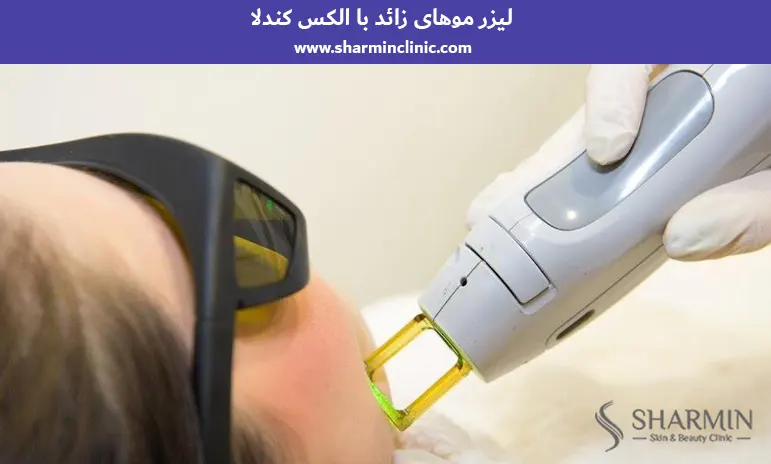 لیزر موهای زائد با الکس کندلا