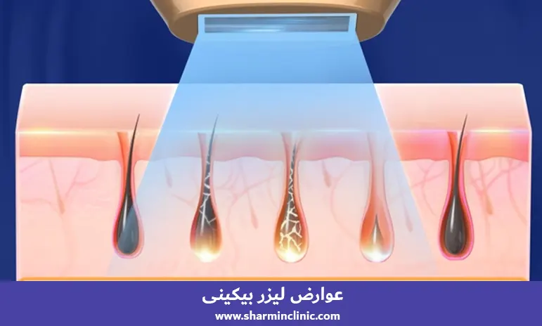عوارض لیزر بیکینی