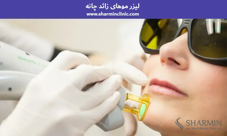 لیزر موهای زائد چانه