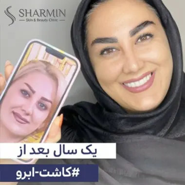 تاثیر مزوتراپی بعد از کاشت ابرو