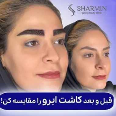 مزو بعد از کاشت ابرو