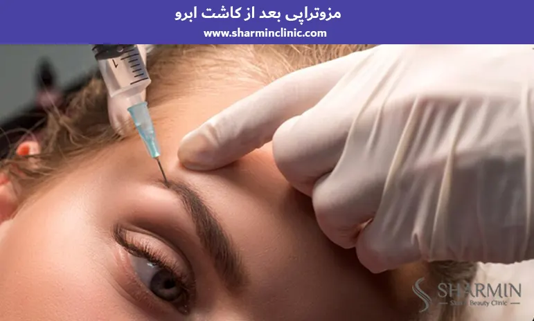 مزوتراپی بعد از کاشت ابرو