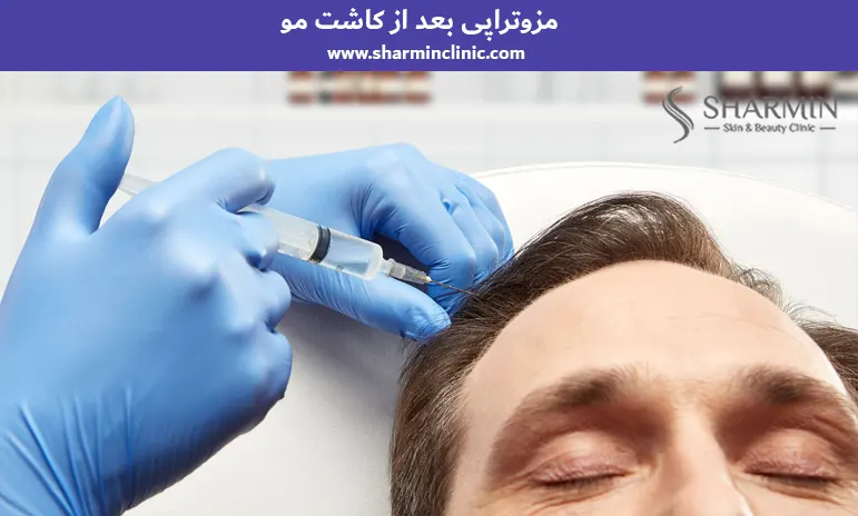مزوتراپی بعد از کاشت مو مزوتراپی بعد از کاشت مو