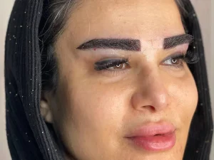 مزایای کاشت ابرو به روش FUE