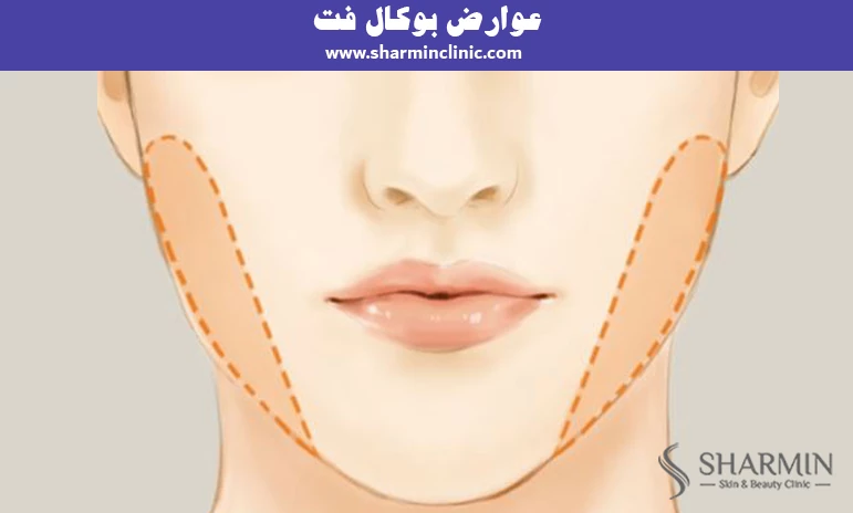 عوارض بوکال فت