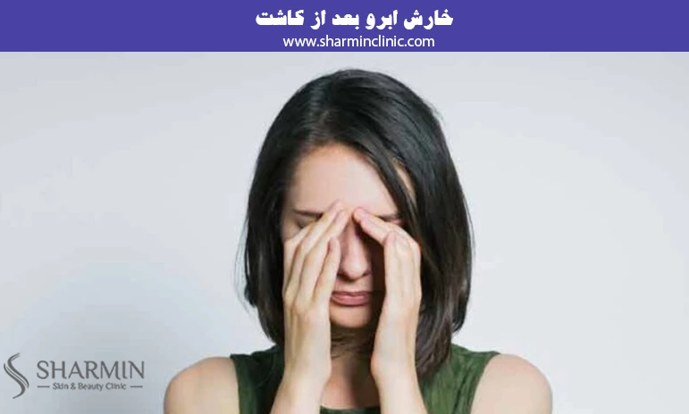 خارش ابرو بعد از کاشت