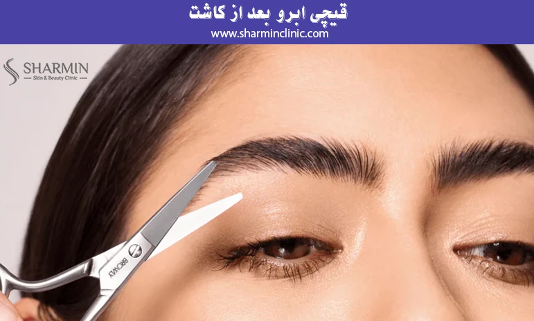 قیچی ابرو بعد از کاشت