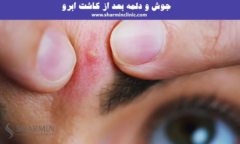 جوش و دلمه بعد از کاشت ابرو