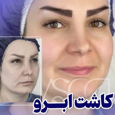خطرات کاشت ابرو در بارداری