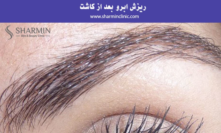 ریزش ابرو بعد از کاشت