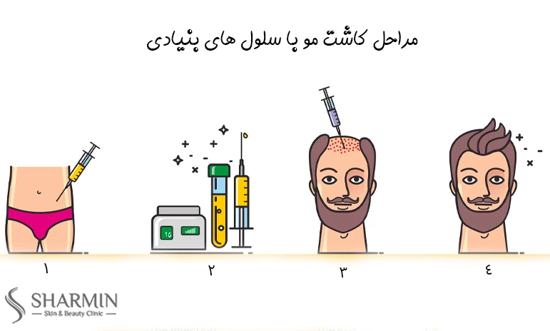 فرایند کاشت مو با سلول های بنیادی