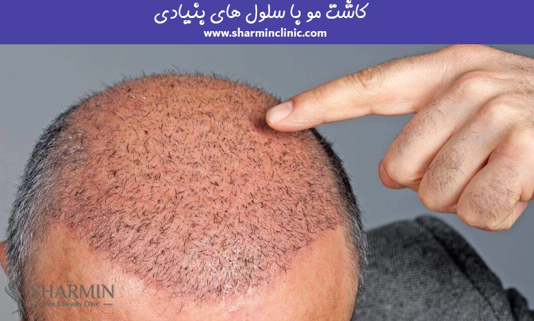 کاشت مو با سلول های بنیادی