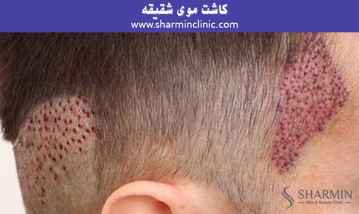 کاشت موی شقیقه