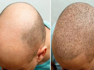 اقدامات قبل از کاشت مو