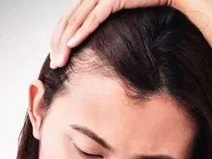 خطرات کاشت مو در بارداری