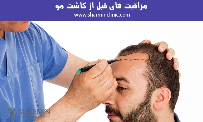 مراقبت های قبل از کاشت مو