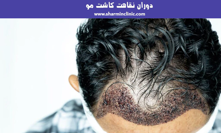 دوران نقاهت کاشت مو
