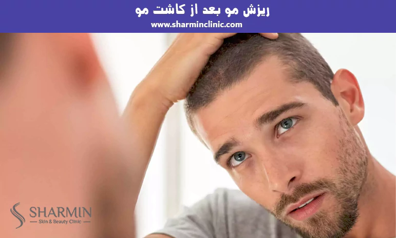 ریزش مو بعد از کاشت مو