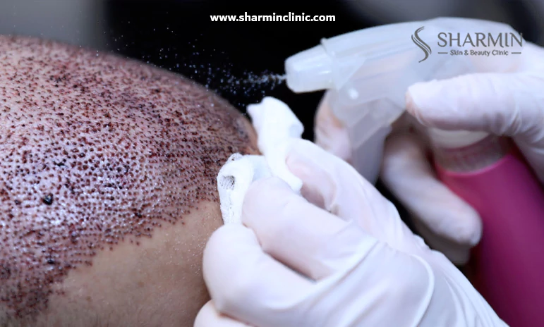 عوارض داشتن رابطه جنسی بعد از کاشت مو