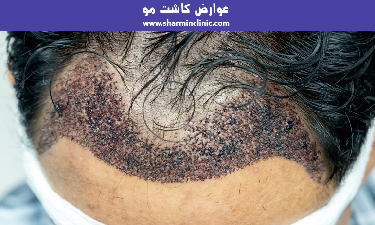 عوارض کاشت مو
