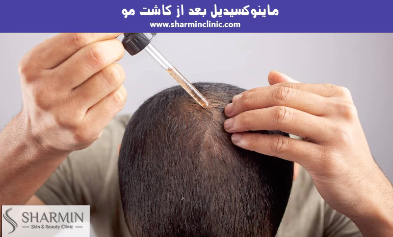 ماینوکسیدیل بعد از کاشت مو