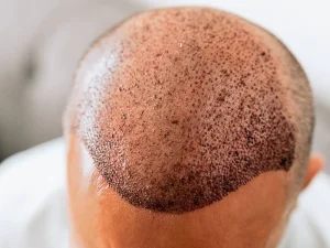 مزایای استفاده از ماینوکسیدیل بعد کاشت مو