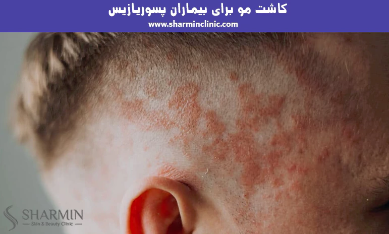کاشت مو برای بیماران پسوریازیس