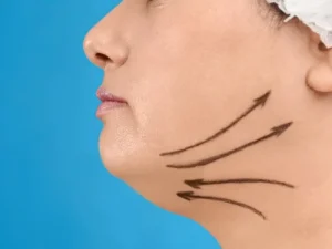 عوارض جانبی ساکشن غبغب