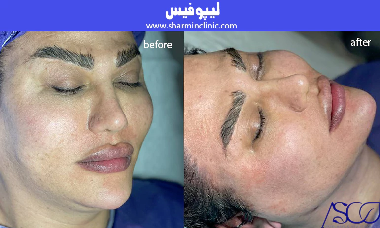 لیپوفیس