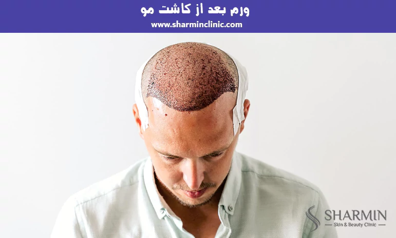 ورم بعد از کاشت مو