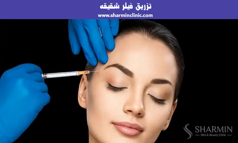 تزریق فیلر شقیقه