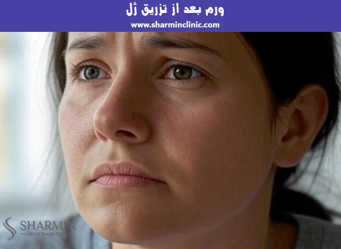 ورم بعد از تزریق ژل