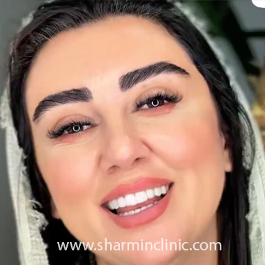 نمونه کار کاشت ابرو شارمین بهترین کلینیک کاشت ابرو سعادت آباد